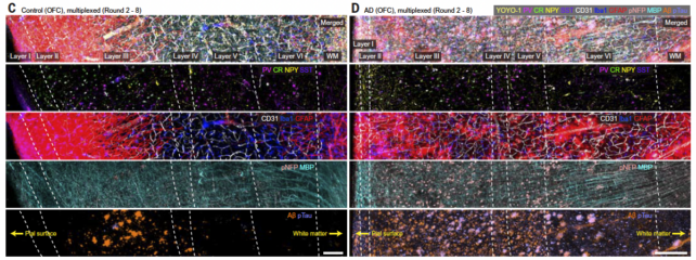 Panel of images showing brain cell layers in Alzheimer's disease and a healthy control. 